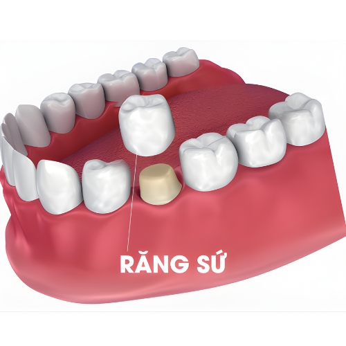 Bọc Răng Sứ
