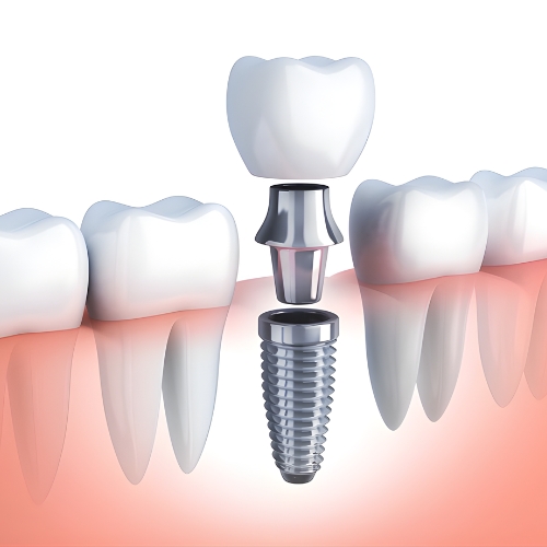 Trồng Implant
